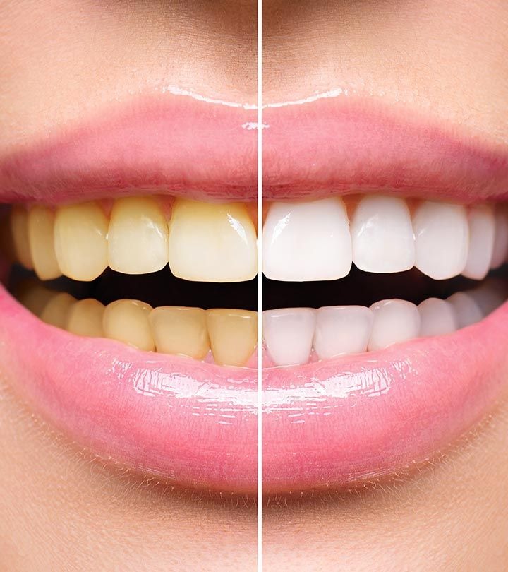 Dentist examining a patient's teeth